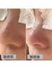 本格毛穴大掃除&スリムムーヴ小顔☆ 通常15000円→初回13000円