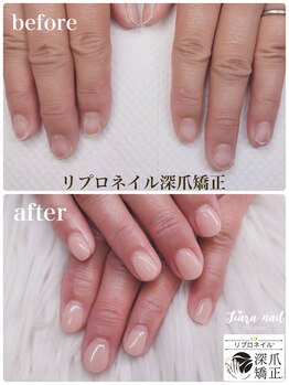 ティアラネイル 宇都宮/リプロネイル深爪矯正コース