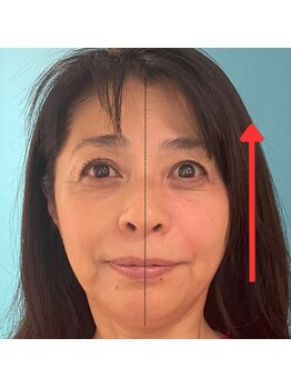 ネクスフィット(Nexfit)/小顔矯正フェイスリフトの効果