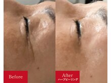 メロー(MELLOW)/ハーブピーリング(50代/シワ)