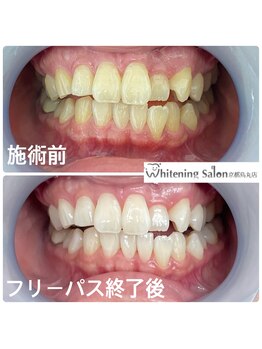 ホワイトニングサロン 京都烏丸店/ホワイトニング施術例