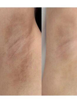 プレジール(PLAISIR)/ローマピンク 脇