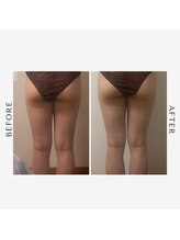 ケアラ(Care.A)/脚集中/スライドカッピング