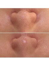 ハーナウ ハウ(hanau hou)/毛穴洗浄