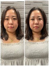 長寿鍼灸院 長寿整骨院/ハリネズミ女優美容鍼効果★