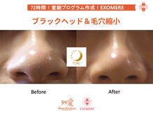 ツキ(TUKI+)/剥けない・ダウンタイム無し