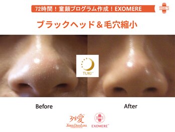 ツキ(TUKI+)/剥けない・ダウンタイム無し