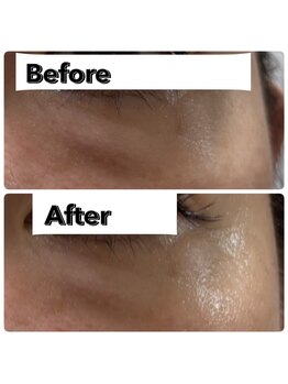 バイオ スキン プラス(Bio Skin Plus)/レモンボトルで目元の膨らみが…