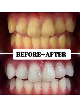 ホワイトニングサロン 宝塚/Before&After美白ホワイトニング