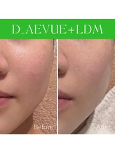 ハナイロ(hana-iro)/肌荒れ・乾燥・赤み改善