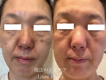 エステティック リベル キョウト 京都駅前店(Esthetic Liber Kyoto)/魔法のシミケア