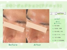ユアーズ ビューティー(YOURS beauty)/スキンジェクション