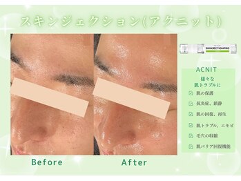ユアーズ ビューティー(YOURS beauty)/スキンジェクション