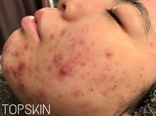 トップスキン 表参道(TOPSKIN)/肌質改善はお任せ下さい！