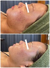 エクセレントビューティーサロン 艶(EN)/水光導入＆REVIハーブ