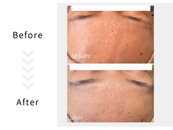 アブニールブリヨン/ハーブピーリング　Before After