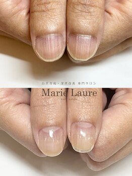 マリーロール 梅田店(Marie Laure)/自爪育成/深爪矯正/ネイルケア