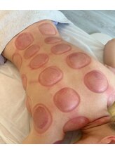 ビレイ(Birei)/カッピング