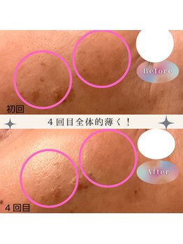 パルティノ 高崎店/シミケア