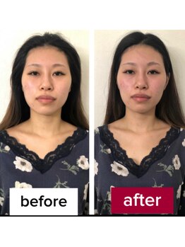 サロンチオリ 烏丸(Salon Chiori)/《30代》目元と頬の左右差改善