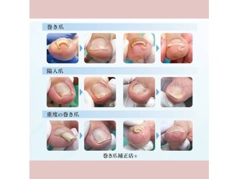 巻き爪補正店 大阪なんば店