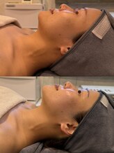 ブリア 横浜(BRILLA)/1回での効果！速攻小顔