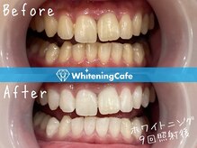 ホワイトニングカフェ 中野店(WhiteningCafe)/ホワイトニングビフォーアフター