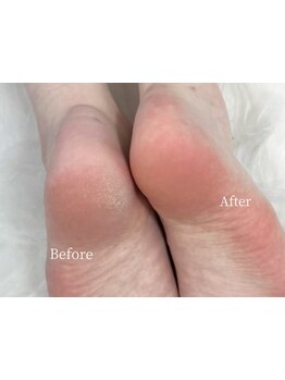 角質ケアができるサロン