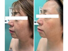 カピリナ(kapilina)/光フェイシャル施術効果