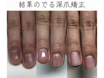 ティアラネイル 宇都宮/深爪矯正