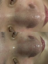 レアリゼ(REALISER)/ハイドラ毛穴洗浄