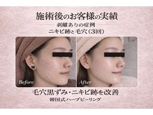 ワイズデュー(Y's Dew)/ハーブピーリング剥離あり3回