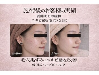 ワイズデュー(Y's Dew)/ハーブピーリング剥離あり3回