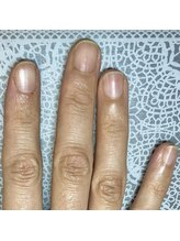 桃の木 吉祥寺店/４０代女性/３回施術後