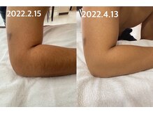 アシヤ髭ラボ(ASHIYA 髭 LABO)/腕毛脱毛ビフォーアフター