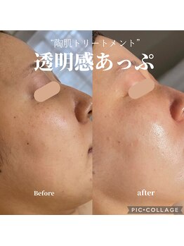 リモナ(Re-mona..)/REVIハ-ブピ-リング【透明感UP】