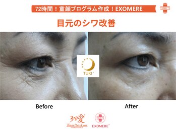 ツキ(TUKI+)/剥けない・ダウンタイム無し