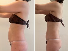 ビューティーマックス(Beauty Max)/痩身　before→after 2ヶ月後