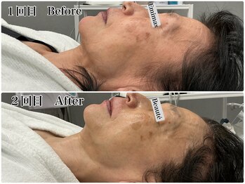 エミマス ボーテ(Emimas Beaute’)/60代前半毛穴洗浄＆幹細胞２回目
