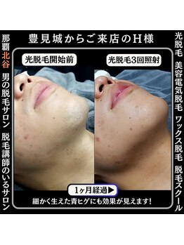 ディースタイル 北谷店(Dstyle)/北谷メンズ脱毛ヒゲBefore after