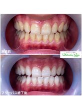 ホワイトニングサロン 名古屋駅店/【ホワイトニング施術例】