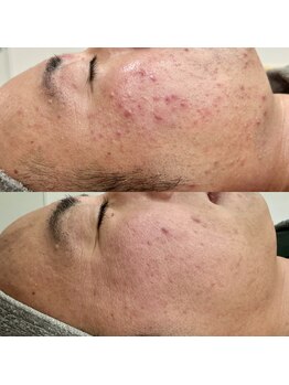 ビオラス(VIOLUS)/大人ニキビ