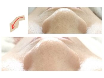 香嬉琉/毛穴洗浄［角栓］before&after