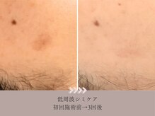 大きくなってしまったシミ悩みにも効果◎