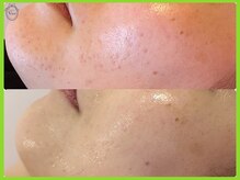 ヴィオール 名古屋栄店(VIOR)/ハーブピーリング