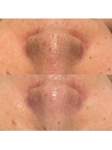 ミューズ(MUSE)/毛穴エクストラクション