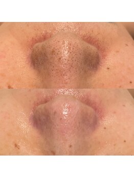 ミューズ(MUSE)/毛穴エクストラクション