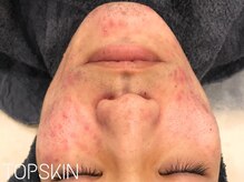トップスキン 表参道(TOPSKIN)/30代メンズのお客様☆ニキビ改善