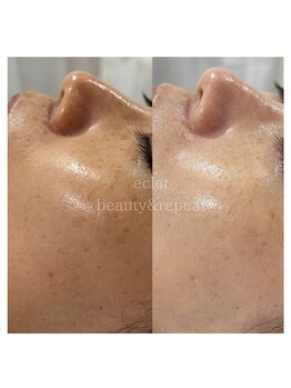 エクラ(eclat)/タラソトリートメント