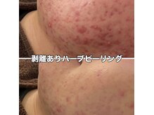 エヌハーブ(NHerb)の雰囲気（お肌を綺麗にしたい(ニキビケア、毛穴、ザラつき、乾燥、赤み)）